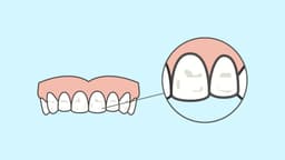 Amelogenesis Imperfecta